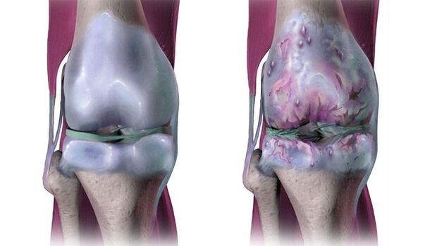 Здоровый коленный сустав и пораженный артрозом