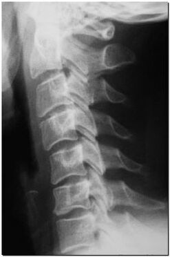 рентгенологический снимок шейного отдела позвночника
