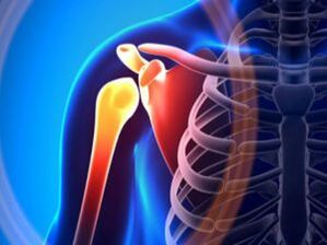Воспаленный плечевой сустав при артрозе – хроническом заболевании опорно-двигательного аппарата